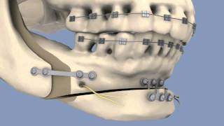 BSSO amp Osseous Genioplasty [upl. by Motch]