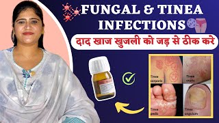 Homeopathic Medicine For Fungal amp Tinea Infections  Fungal Infection Treatment  Dr Arwa Bohra [upl. by Adolph603]