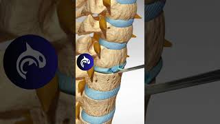 See how an Artificial Cervical Disc Replacement of the Spine works in 3D animation [upl. by Goda]