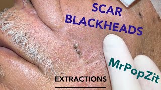 Giant blackheads imbedded in scar tissue extracted Common occurrence with surgical procedures [upl. by Anaek]