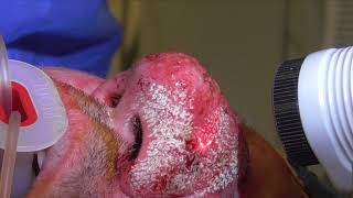 Rhinophyma Removal Incredible Results [upl. by Emad499]