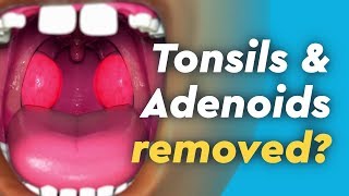 Tonsils and Adenoids Surgery [upl. by Niowtna]