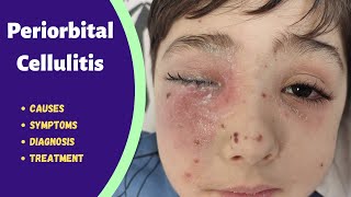 Eyelid infection  Periorbital cellulitis [upl. by Mora774]