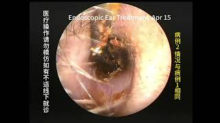 Cerumen embolism caused by cleaning cotton swabs [upl. by Aratahc]