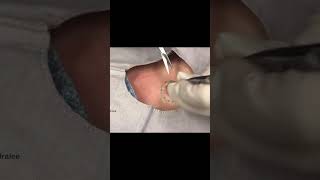 Satisfying Epidermoid Cyst 🧄 shorts [upl. by Airehtfele873]