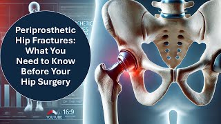 Periprosthetic Hip Fractures What You Need to Know Before Your Hip Surgery [upl. by Harad]