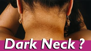 DIY Home Remedies For Dark Neck [upl. by Dajma18]