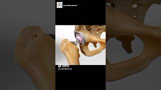 Total Hip Replacement Procedure  Animation [upl. by Ttevy]