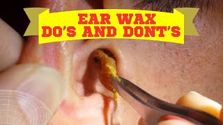 How To Remove Ear Wax Doctor Dos and Donts [upl. by Fillbert]