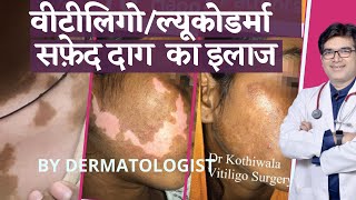 Vitiligo Leucoderma Treatment In Hindi सफ़ेद दाग़ कारण इलाज  Dermatologist  Dr Sunil Kothiwala [upl. by Peednam]