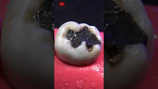 Restauración dental satisfying [upl. by Emelina386]