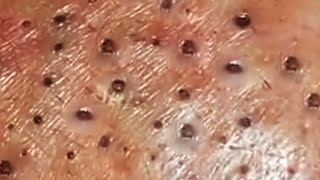 Deep blackhead extraction Cystic acne amp pimple popping 86 [upl. by Clotilda]