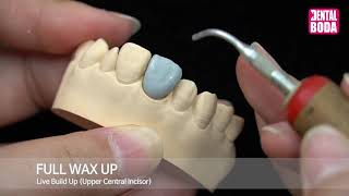 Full wax up Upper Central Incisor [upl. by Athalla]