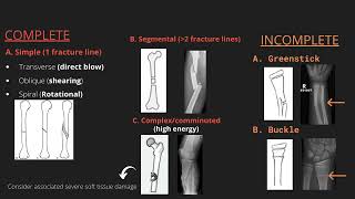 Approach to describing fractures on xray [upl. by Pedroza]