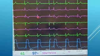 7 Pericardiocentesis  Confirming Location [upl. by Eugenides]