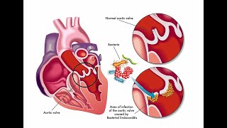 Treatment For Infective Endocarditis [upl. by Horten645]