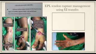 Extensor Pollicis Longus tendon rupture management using Extensor Indicis tendon transfer [upl. by Zzabahs355]