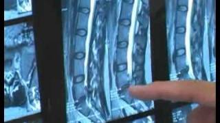 Introduction Lumbar Micro Discectomy Part 1 Jack Chen MD [upl. by Nnylasor242]