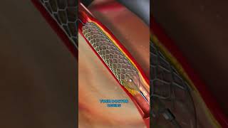 Treatment for coronary artery diseaseVaporizing coronary blockages3D👍shorts short shortvideo [upl. by Hollinger]