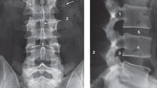 x ray Lumbosacral spine made easy [upl. by Nyhagen]