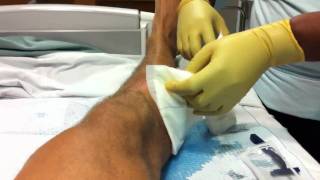 R Leg Abscess I amp D [upl. by Penney]