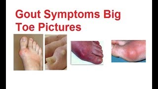 🔥Top 7 Gout Foot amp Big Toe HOME Treatments 1 BIG SECRET [upl. by Arema949]