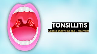 Tonsillitis Causes Signs and Symptoms Diagnosis and Treatment [upl. by Ackley]