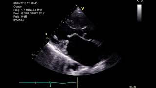 Rétrecissement mitral Image échographique bidimensionnelle 1 [upl. by Onilecram]