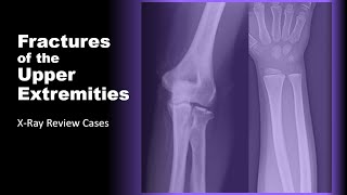 Fractures of the Upper Extremities on XRay radiology xray doctor [upl. by Noraha]