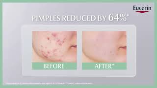 Reduce acne in 7 days with ProACNE Solution AI Clearing Treatment [upl. by Cinimod]