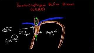 Pathophysiology of Gastroesophageal Reflux Disease GERD [upl. by Oine500]