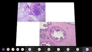 benign proliferative breast lesions [upl. by Cumings]