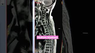 Multiple Myeloma Spine MRI viral mri youtubeshorts [upl. by Lasser]