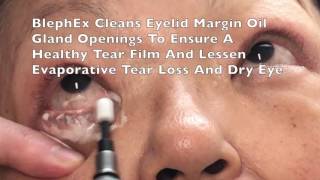 BlephEx Eyelid Treatment For Dry Eyes Blepharitis by Dr Burroughs in Colorado Springs [upl. by Ayhtnic]