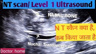 NT scan Level 1 ultrasound Pregnancy ultrasound Doctor home [upl. by Meave355]