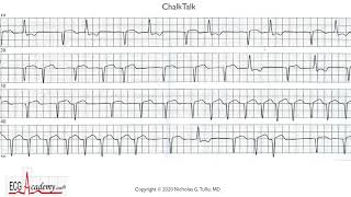 Premature Beats  Atrial with Aberrancy or Ventricular How to Tell FOR SURE [upl. by Luamaj]