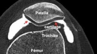 Chondropathierotule3D Arthroscanner [upl. by Adalheid]