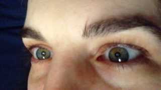 What Sectoral Heterochromia Looks Like In Eyes [upl. by Lichter]