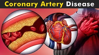 How Coronary Artery Disease Work  Symptoms Causes And Treatment UrduHindi [upl. by Dnomhcir]