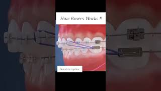 This is how braces work [upl. by Tench]