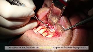 La Chirurgie Endodontique  Dr Matthieu Marret [upl. by Eekaz881]