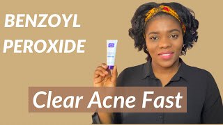 Acne Treatment  How to use BENZOYL PEROXIDE for ACNE  Dr Janet [upl. by Donnie]