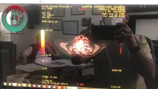 PETCT Tomografía por emisión de positronesTomografía Computada en Cáncer Pulmonar [upl. by Flo377]