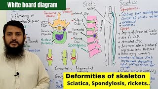 Deformities of skeleton part 02  Disc Slip  Spondylosis  Sciatica  Arthritis [upl. by Raila]