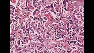 Histopathology LiverCholangiocarcinoma moderately well di [upl. by Ornas]