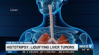 YOUR HEALTH Histotripsy Liquifying liver tumors [upl. by Jethro3]