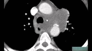 56yoM CXR CT Chest Adenopathy Discussed by Radiologistmp4 [upl. by Zenda971]