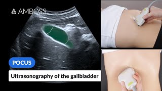 Point of Care Ultrasound of the Gallbladder  AMBOSS Video [upl. by Balfore773]