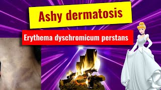 Ashy dermatoses Erythema dyschromicum perstans overview features histology management [upl. by Bullis]