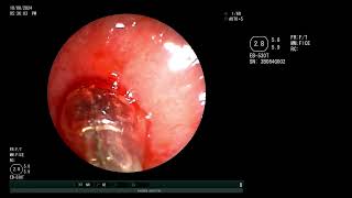 Emergent Central airway obstruction Subglottic stenosis  Dilatation and silicone stent placement [upl. by Stortz]